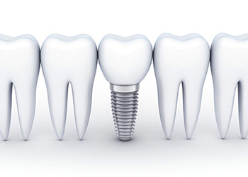problems with dental implants