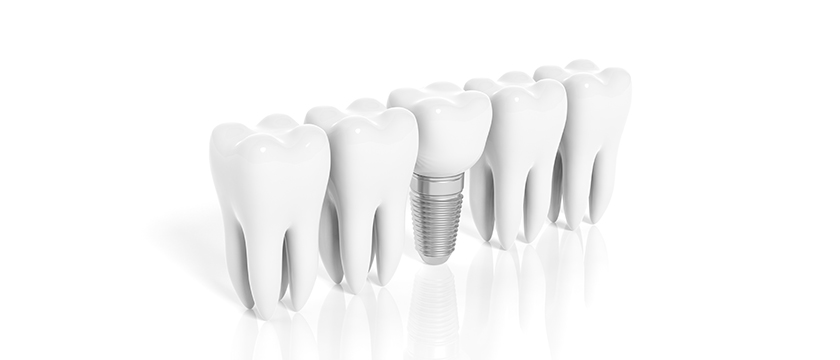 Getting Dental Implants Overseas: Know the Risks!