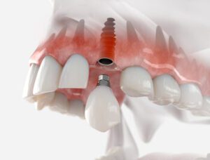 Dental Implants in Perth