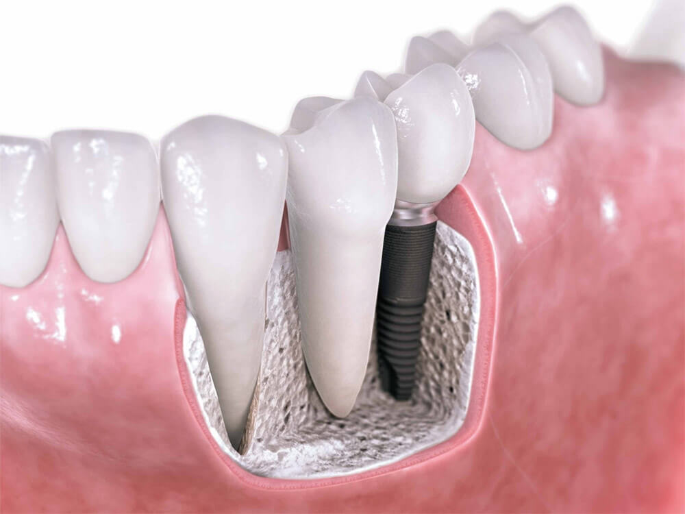 dental implant procedure