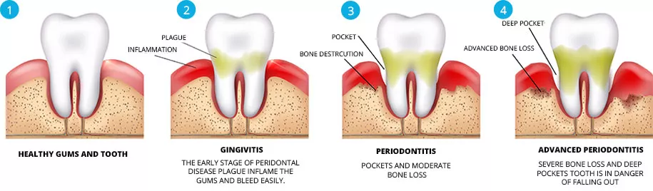 Dental Gums