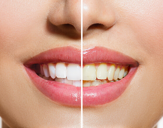 Teeth Whitening Body