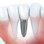 dental implant