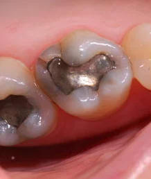 Dental Fillings