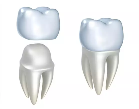 Dental Crowns