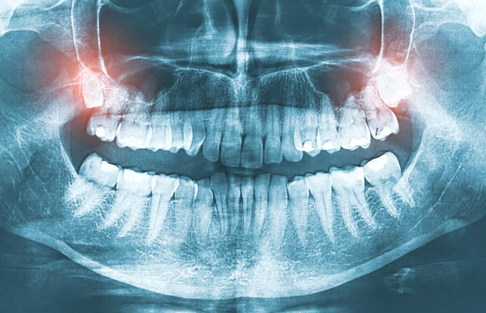 dental extraction