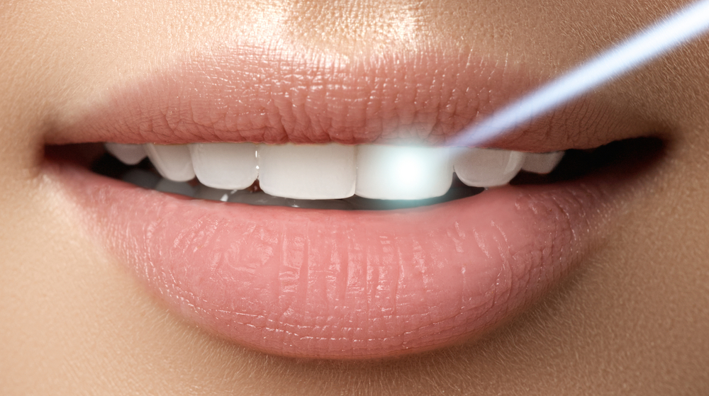 Perfect,Smile,After,Bleaching.,Dental,Care,And,Whitening,Teeth.,Laser