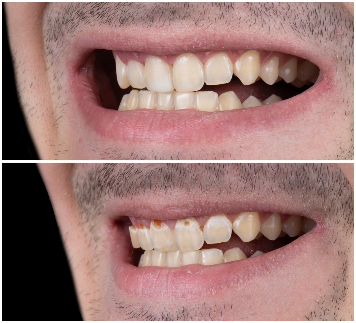 Everything You Need to Know About Cost of Composite Veneers