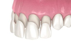 dental veneers treatment burwood