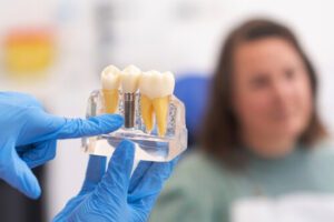 Single Tooth Implant Cost Australia explanation burwood