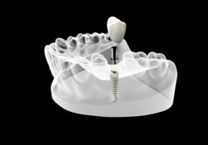 single-tooth-implant-cost-australia-illustration-burwood
