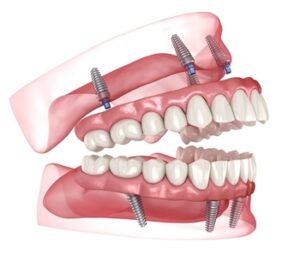 Cost-For-Full-Mouth-Dental-Implants-image-burwood