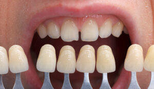 advantages of porcelain veneers burwood