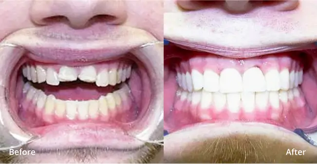 dental implants before vs after D266 2