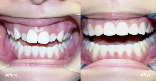 Orthodontics before vs after D266 2