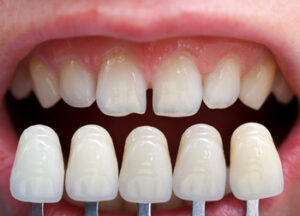 types porcelain veneers burwood