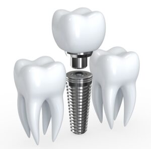 foreign dental implants burwood