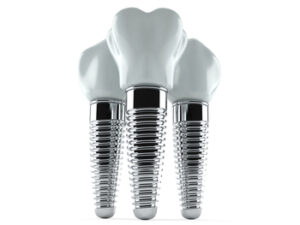 tooth implant overseas burwood