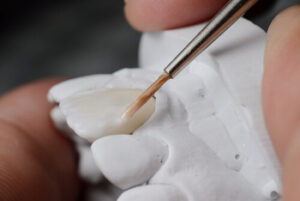 veneers cost philippines application burwood