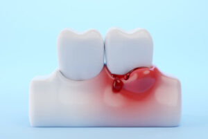 Can You Get Veneers With Gum Disease symptoms