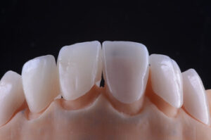 Can Veneers Fall Off set
