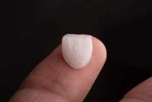 Can Veneers Fall Off shell