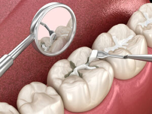 Temporary Tooth Filling placement
