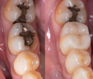 Temporary Tooth Filling replacement