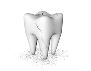 Root-Canal-vs-Extraction-crack