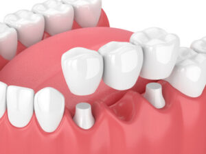 Dental Bridge Types use
