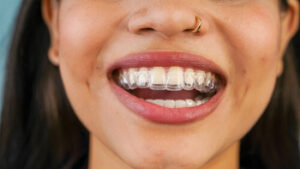 Is Invisalign Worth It wear