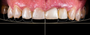 What Causes Root Canal decay