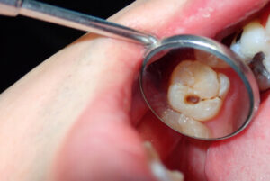 What Causes Root Canal indication