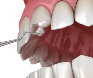 Composite Bonding Price Australia procedure