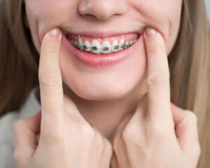 What to Eat with Braces the First Week of use