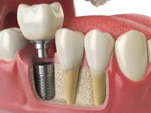 50 Soft Foods to Eat After Dental Implant Surgery appliance