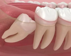 How to fix crooked teeth impacted