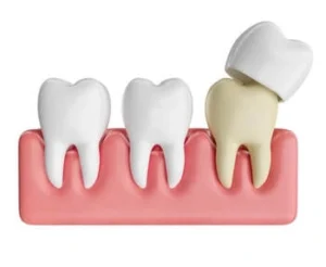 What Do Teeth Look Like Under crown