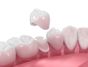 crown shown to be applied on tooth