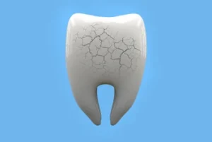 broken or cracked tooth extraction