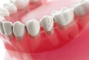 What Is Enamel Made Of and How It Protects Your Teeth