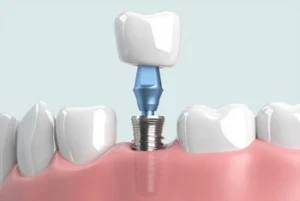 Abstract illustration representing AI technology in modern dental surgery