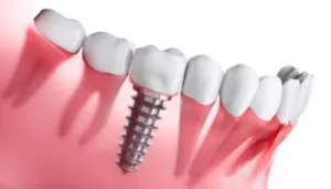 Types of Dental Implants procedure