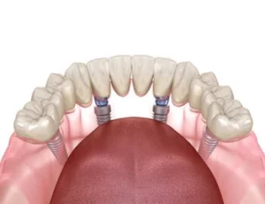 Full Arch Dental Implants