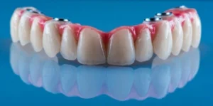 full mouth Dental Implants Payment Plans types