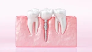 is dental implant safe last