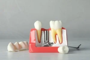 what is a dental implant illustration