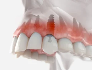 A stylized 3D rendered implant with a transparent gum showing internal anatomy.