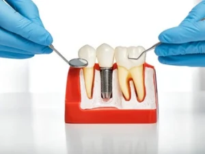 How Long Do Dental Implants Take bone graft