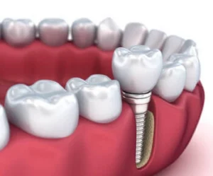 Truth About Dental Implants cost image